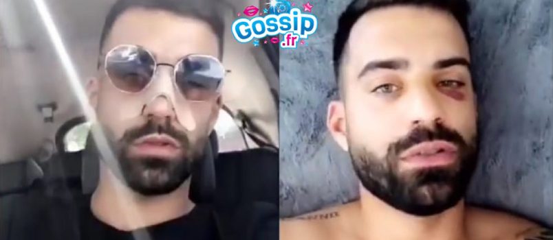 VIDEO - Vincent Queijo: Cocard et nez fracturé après une bagarre avec un groupe!